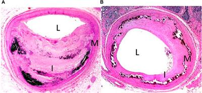 The cardiovascular changes underlying a low cardiac output with exercise in patients with type 2 diabetes mellitus